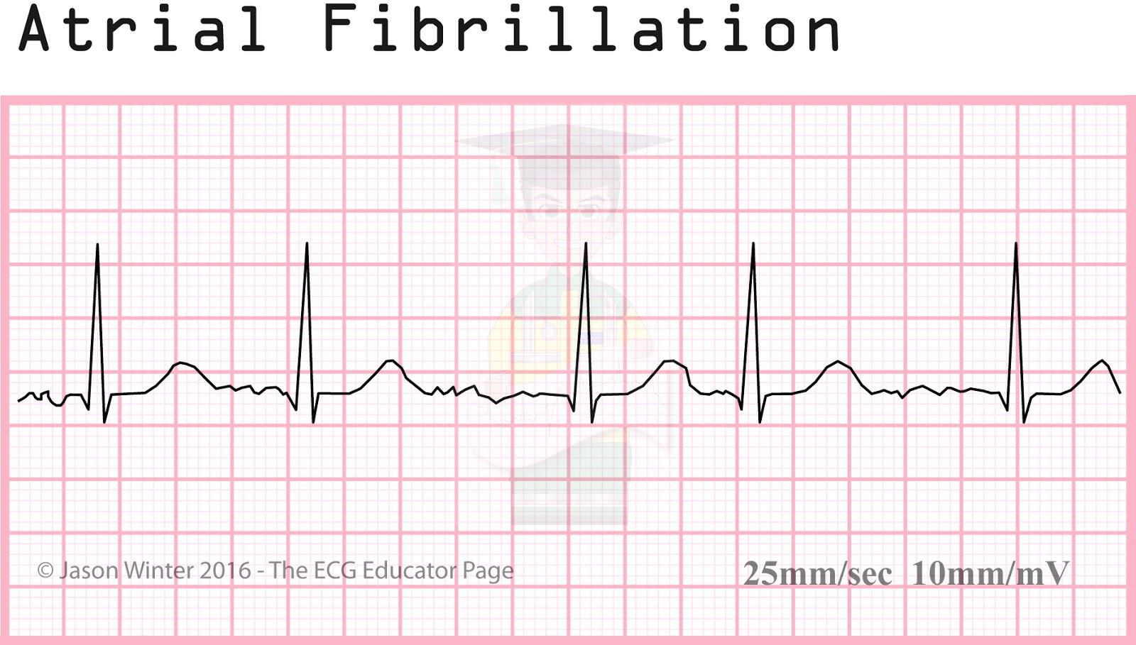 Atrial Fib Strip