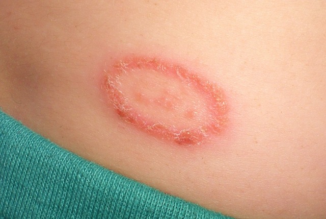 Ringworm Pictures, Treatment, and Tinea Facts - MedicineNet