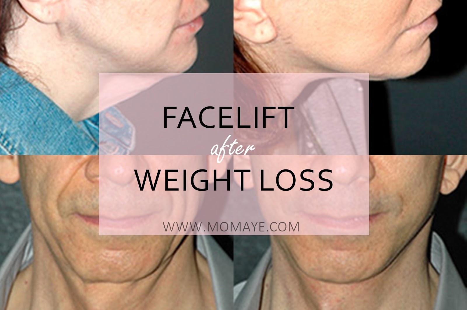 Facelift After Weight Loss