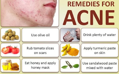 adult acne home remedies