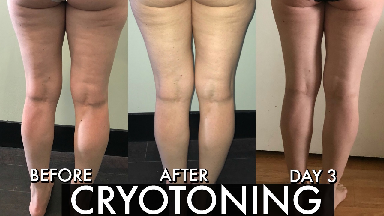 Cryoskin Toning Before And After