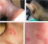 obat Gatal Eksim Di Leher obat Gatal Eksim Di Leher