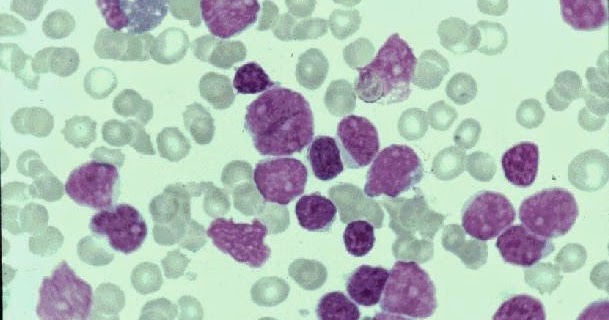 HEMATOLOGIA LINFOMA DE CÉLULAS DEL MANTO