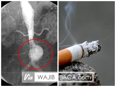 Penelitian Baru, Merokok Bisa Bikin Pembuluh Darah Meledak! SEBARKAN! Penelitian Baru, Merokok Bisa Bikin Pembuluh Darah Meledak! SEBARKAN!