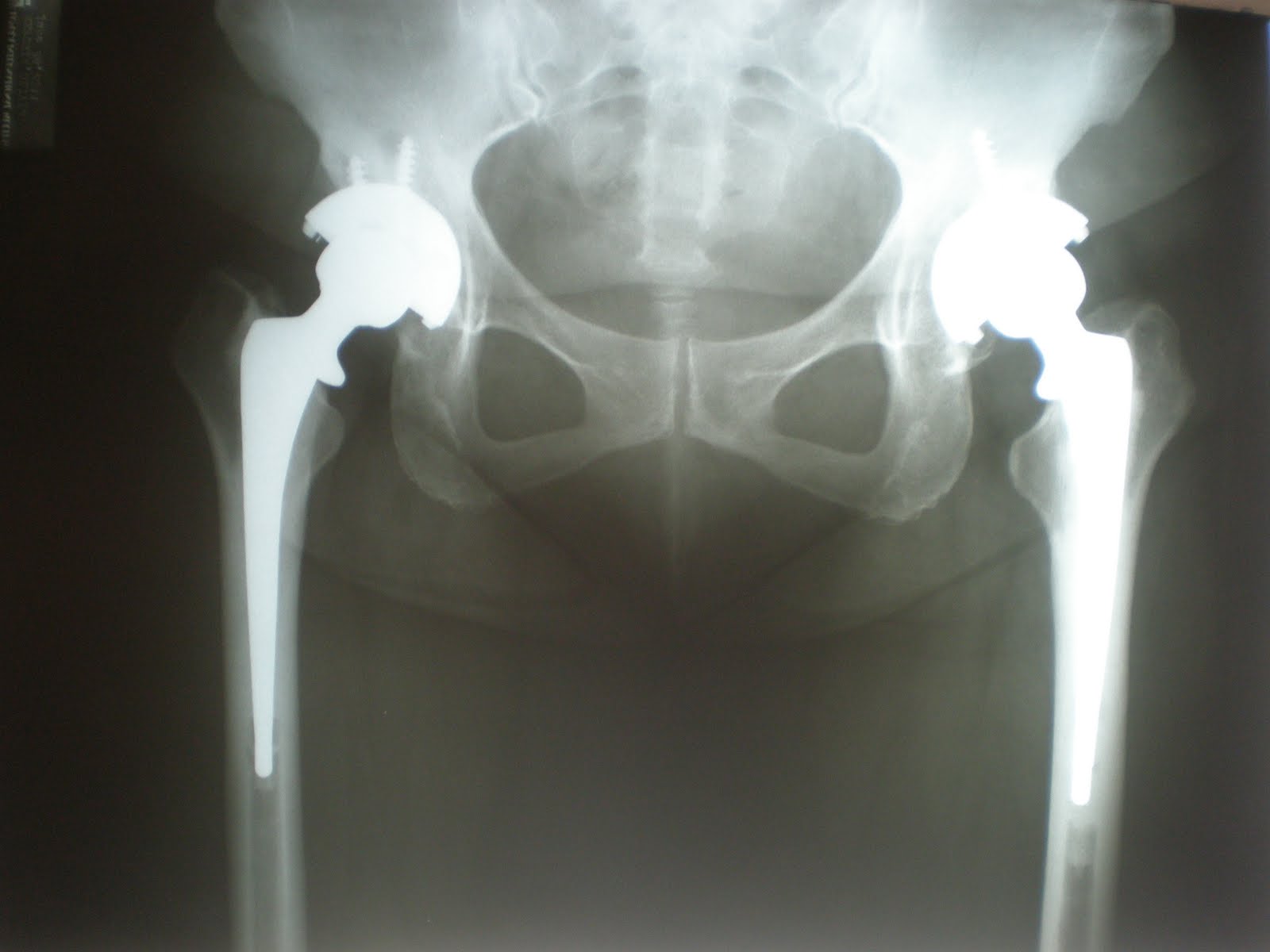 Pinoy Bone and Joint Total Hip Replacement What You Need to Know