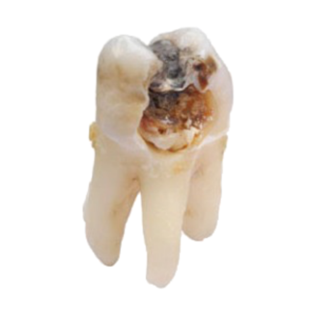 DENTAL TALKS Post Operative Instructions After a Root Canal Treatment