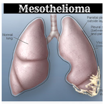 https://mesotheliomaasbestospro.blogspot.com/2018/06/about-mesothelioma-do-you-know.html