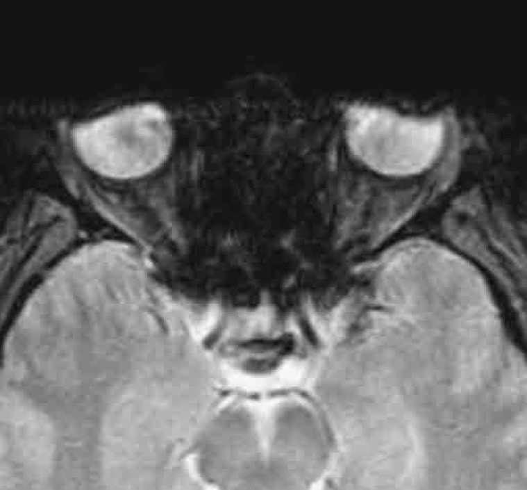 Dr Balaji Anvekar FRCR Artifact from Eye Makeup