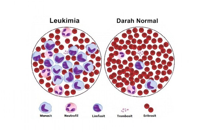 10 Gejala Leukimia yang Sering Diketahui - Obat Sakit 2011