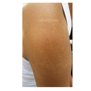 Homeopathy for PITYRIASIS VERSICOLOR