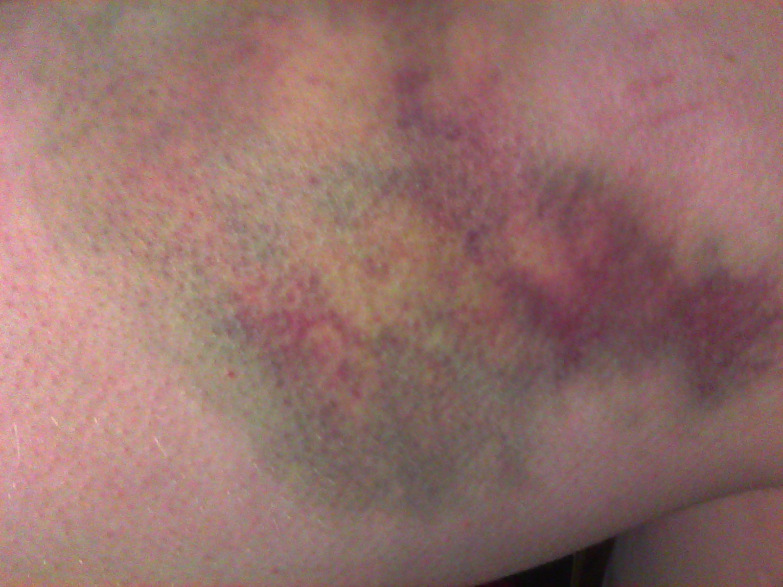 Painful Bruise On Hip 4 Primary Hip Flexors Pain painful-bruise-on-hip-4-primary-hip-flexors-pain