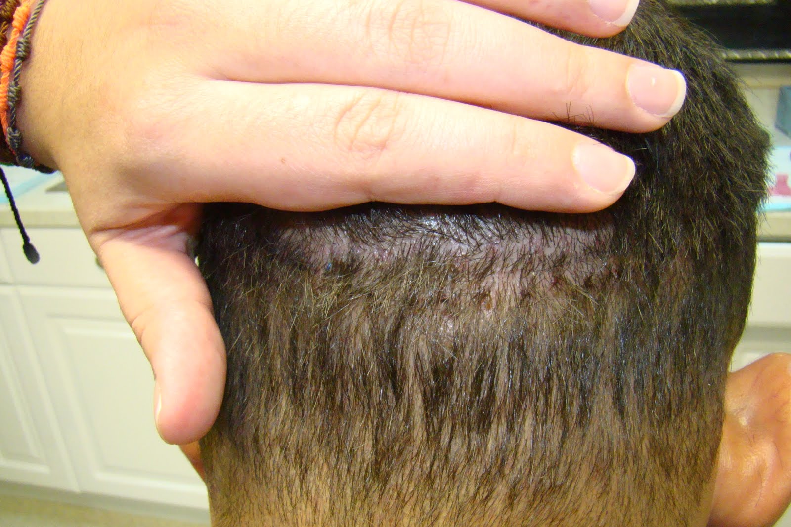 Hair Transplant Scar Dr. Brett Bolton Blog