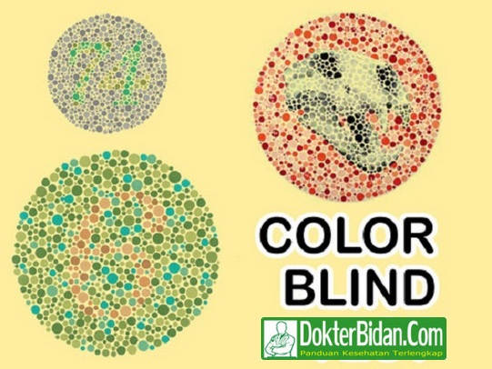 Buta Warna Color Blind Test - Penyebab, Gejala, Diagnosis, Pencegahan Dan Pengobatan Terbaik Buta Warna Color Blind Test - Penyebab, Gejala, Diagnosis, Pencegahan Dan Pengobatan Terbaik