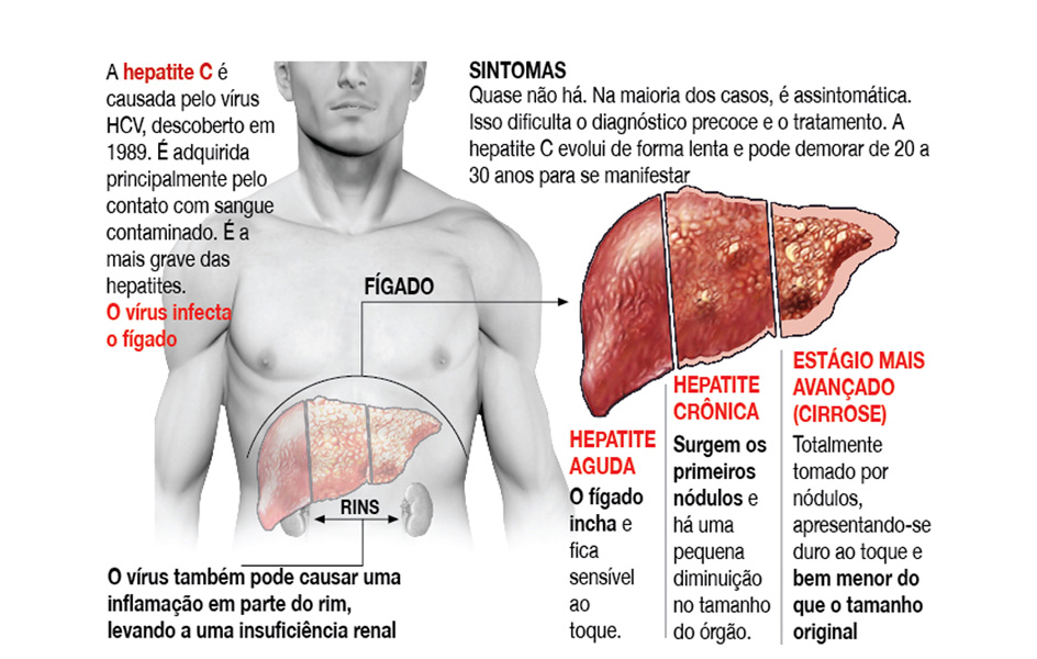 Novo exame para Hepatite C será