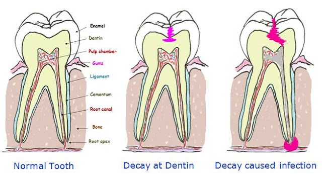 Tooth Pain