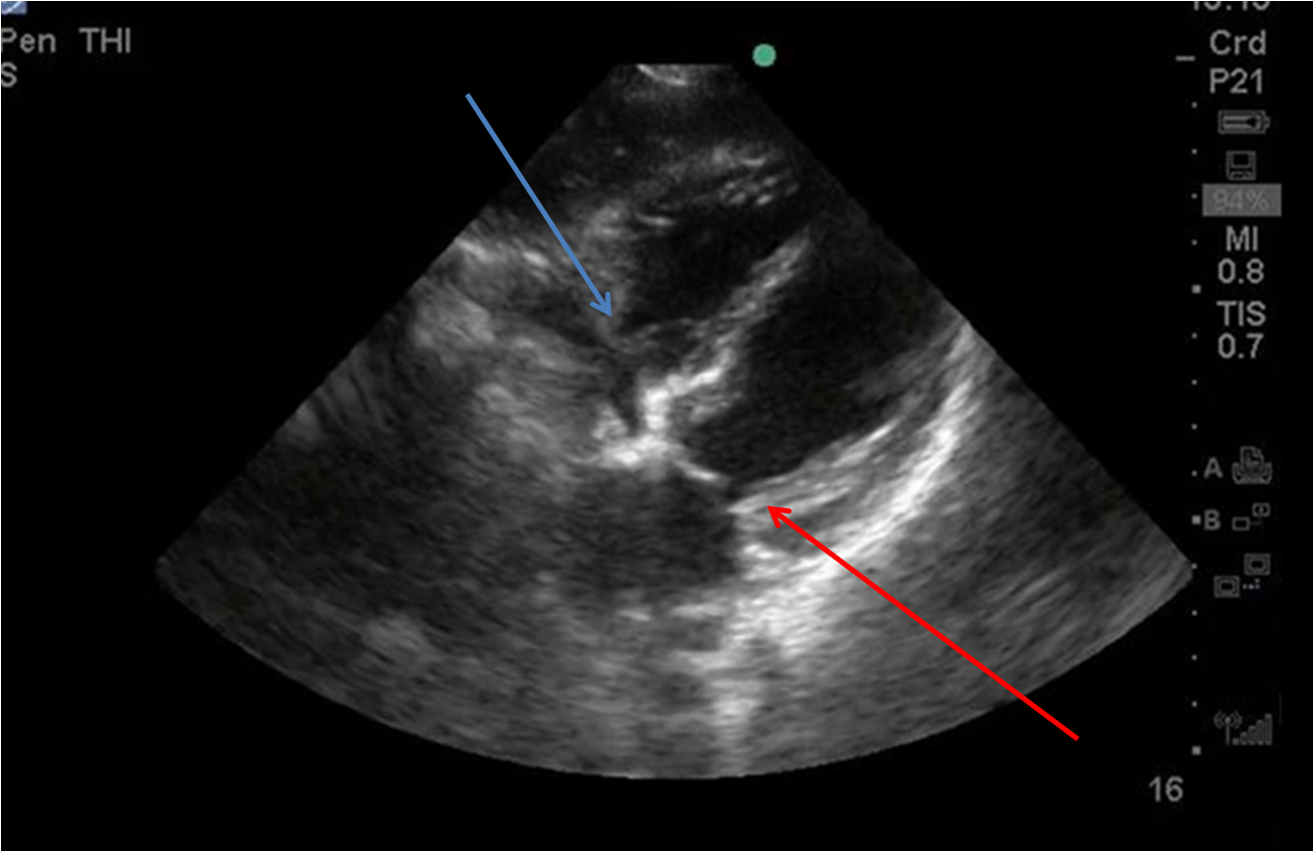 Dr. Smith's ECG Blog COPD exacerbation, what do the ECG and bedside