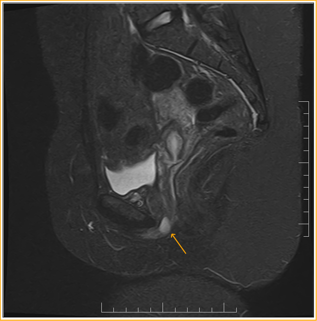 Urethral Diverticulum MRI Sumer's Radiology Blog