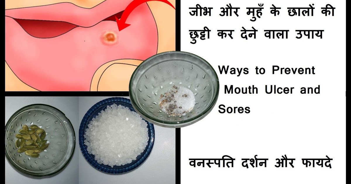 Ways to Prevent Mouth Ulcer and Sores Education and Information