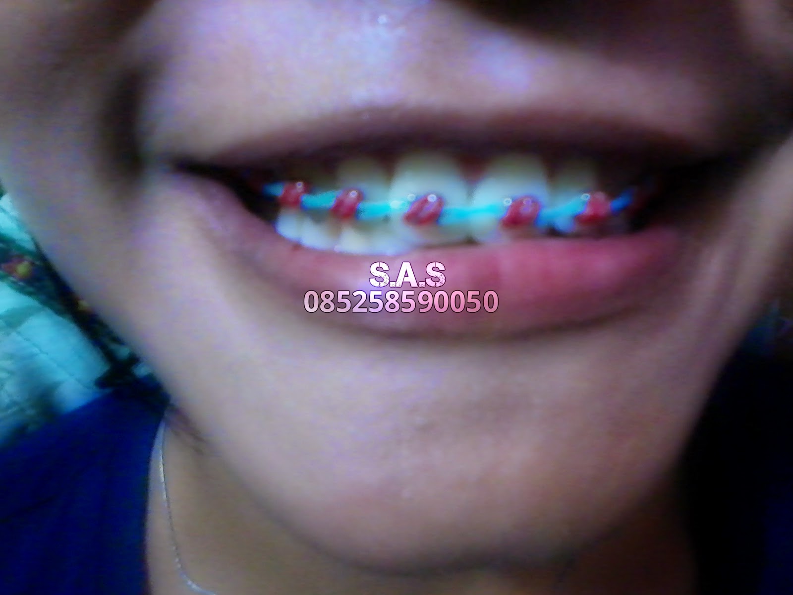 Ide 23 Warna Karet Behel Yang Bagus