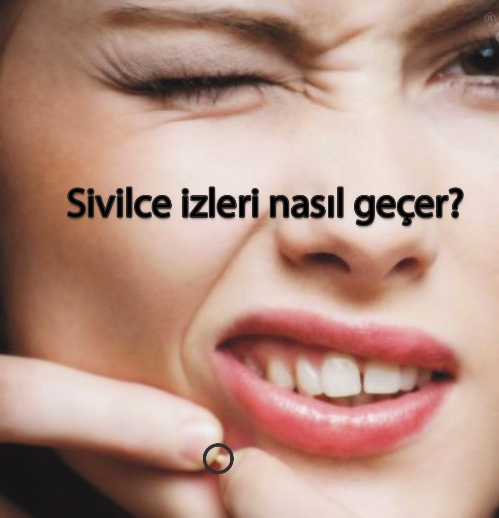 Sivilce İzleri Nasıl Geçer? Sivilce nasıl geçer?