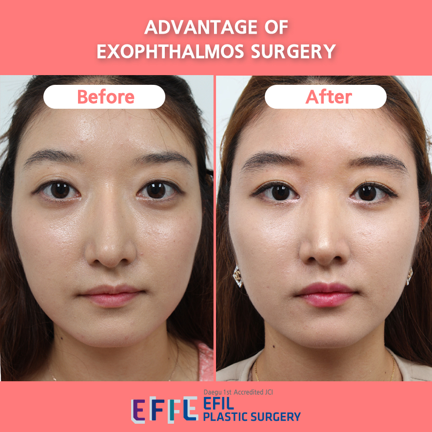 EFIL Bulging Eyes Plastic Surgery JCI exophthalmos surgery cost at