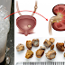 Easy Ways To Remove Kidney Stones With The Help Of This Natural Treatment