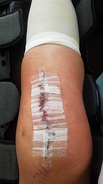photo of a very swollen and inflamed leg with a line of stitches
