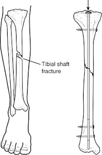 Times Of Teenz: Tib-Fib Fracture