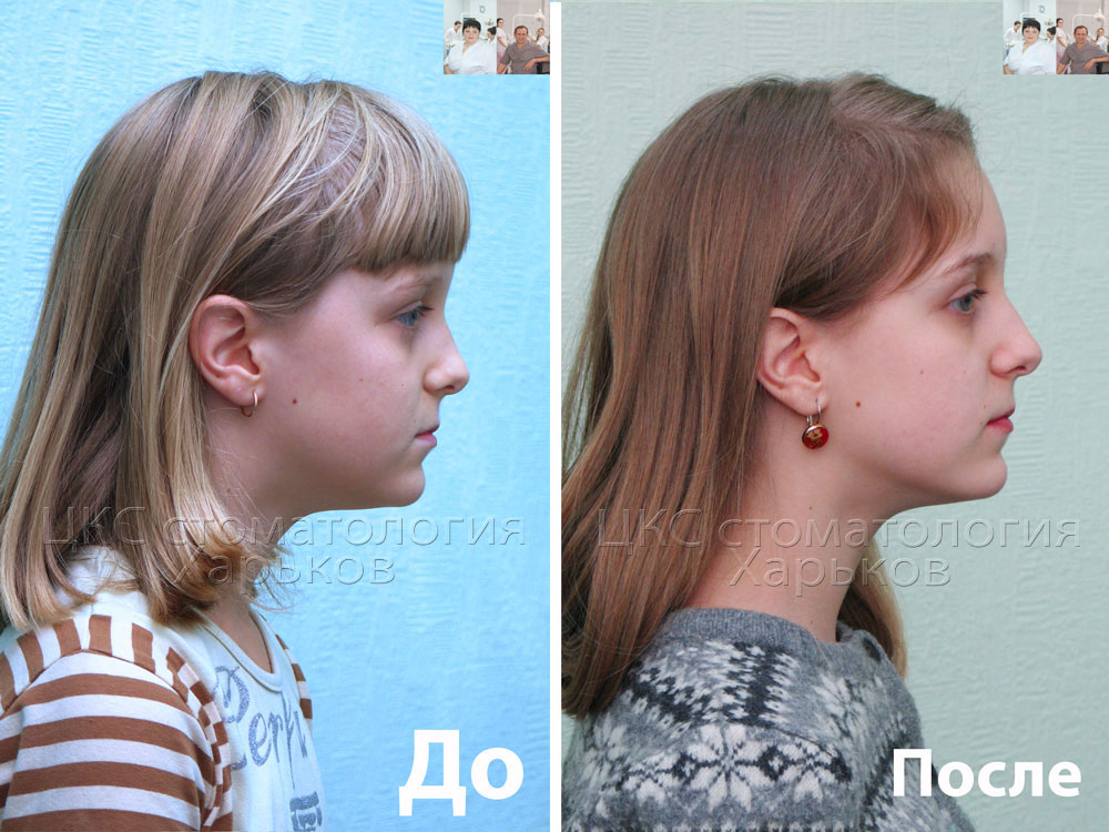аденоидное лицо до и после. пластика подбородка (ментопластика): липофилинг. аденоидный тип лица профиль. аденоидное лицо до и после. аденоидное лицо у ребенка до и после.