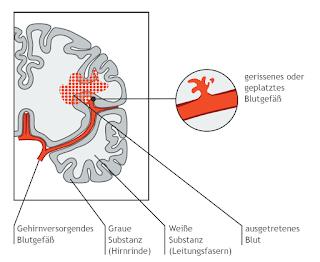 durchblutungsst rung gehirn - woodenbild :)