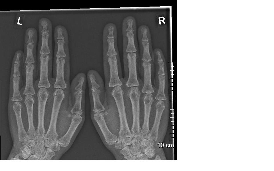 Rheumatologe Chest Xray and nail clubbing