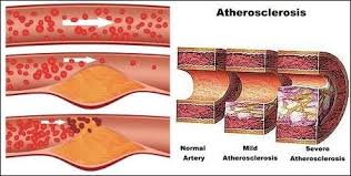 Cara Mengobati Aterosklerosis Cara Mengobati Aterosklerosis