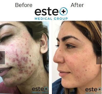 acne treatment Birmingham