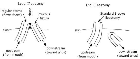 Loop Ileostomy | www.pixshark.com - Images Galleries With A Bite!