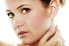 Natural Remedies to Treat ACNE / PIMPLES