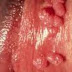 Obat kutil kelamin/jengger ayam thumbnail