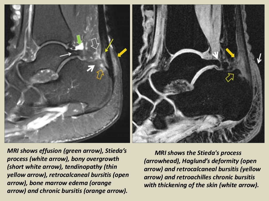 MRI Musculo-Skeletal Section: Bursa of ankle joint.