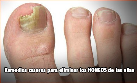 Remedios naturales para hongos unas manos