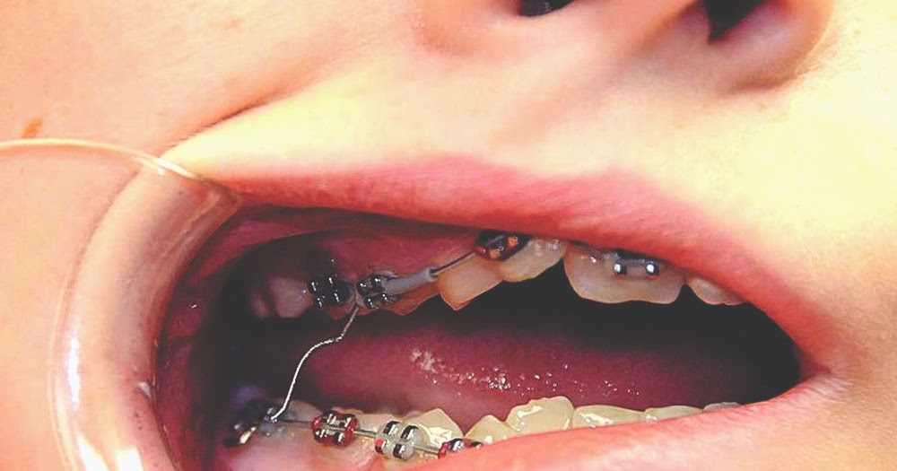 ORTHODONTICS How To Handle Braces Emergencies Wire Poking, Sore Teeth Directorio Odontológico