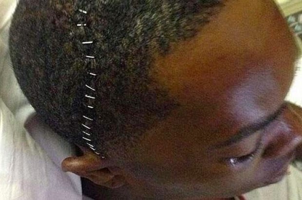 Aroldis Chapman sube foto a Instangram de su cabeza grapada luego de cirugía. 