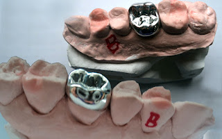 ondotologico  Plano Odontológico com Prótese amil dental rede credenciada convenio odontologico   #PlanoOdontológicocomPrótese  #planoondotologico