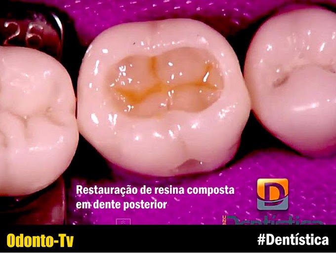 DENTÍSTICA: Restauração de resina composta em dente posterior