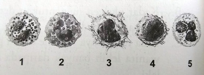 Eosinofil yang memiliki ciri – ciri berdiameter 12 – 15 µm,inti sel