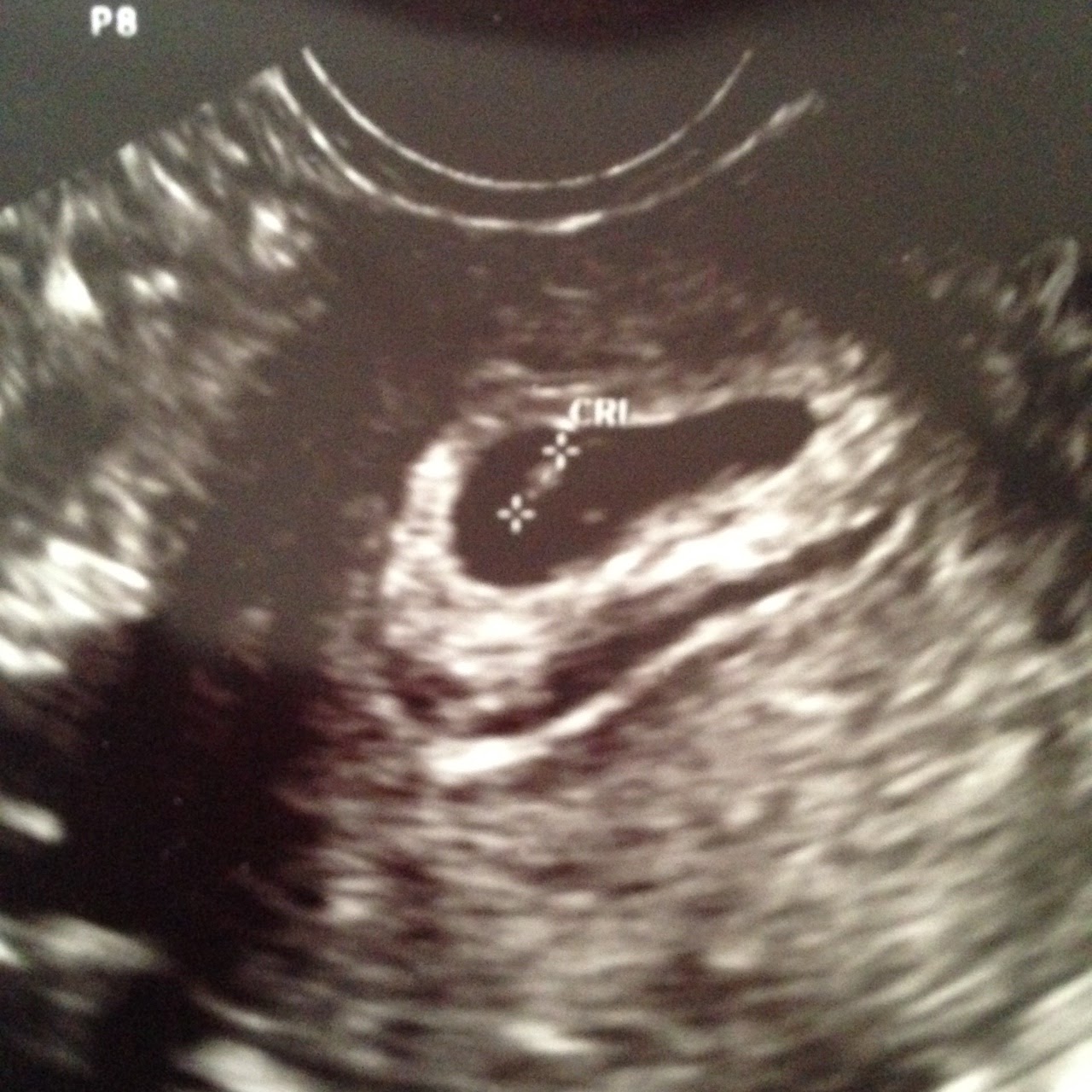 What Is A Subchorionic Hematoma