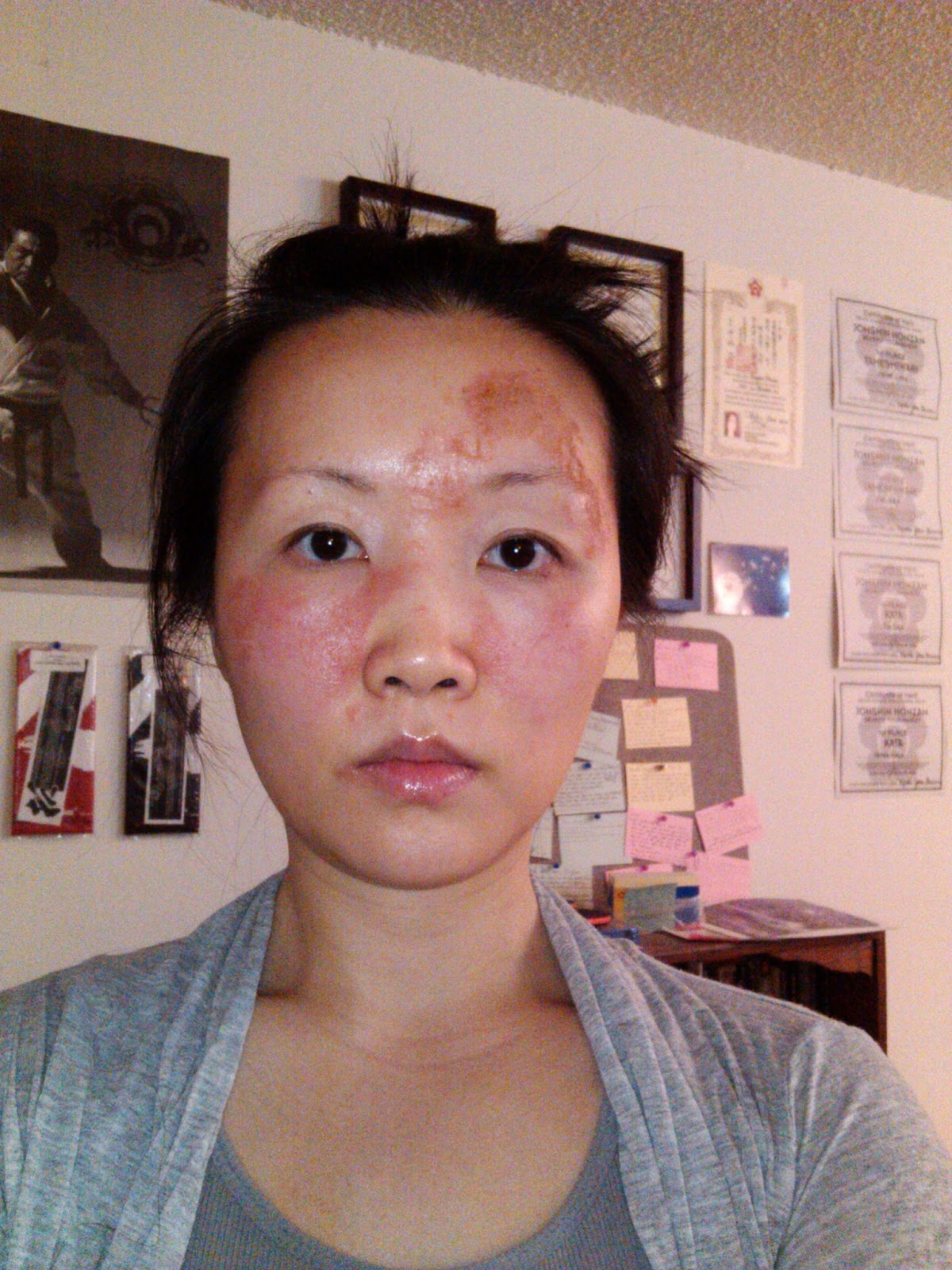 sandpaper rash on face #11