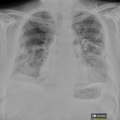 Asbestos related pleural calcification