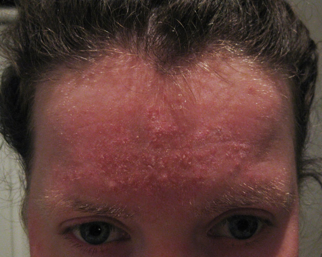 Scarlet Letters, dealing with vascular rosacea, face flushing, burning