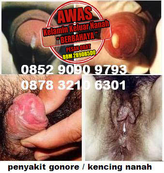 Ramuan Tradisional Pengobatan Kencing Nanah Ramuan Tradisional Pengobatan Kencing Nanah
