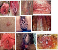 Pengobatan Kutil Kelamin Paling Ampuh Pada Vagina Pengobatan Kutil Kelamin Paling Ampuh Pada Vagina