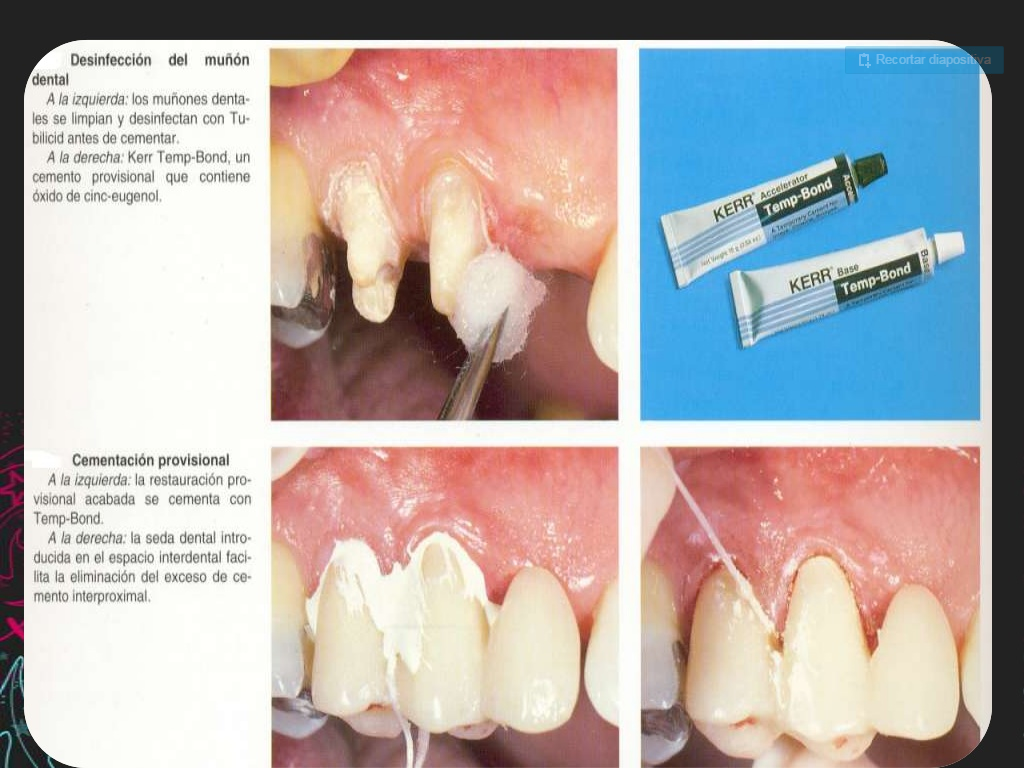 Provisionales dentales